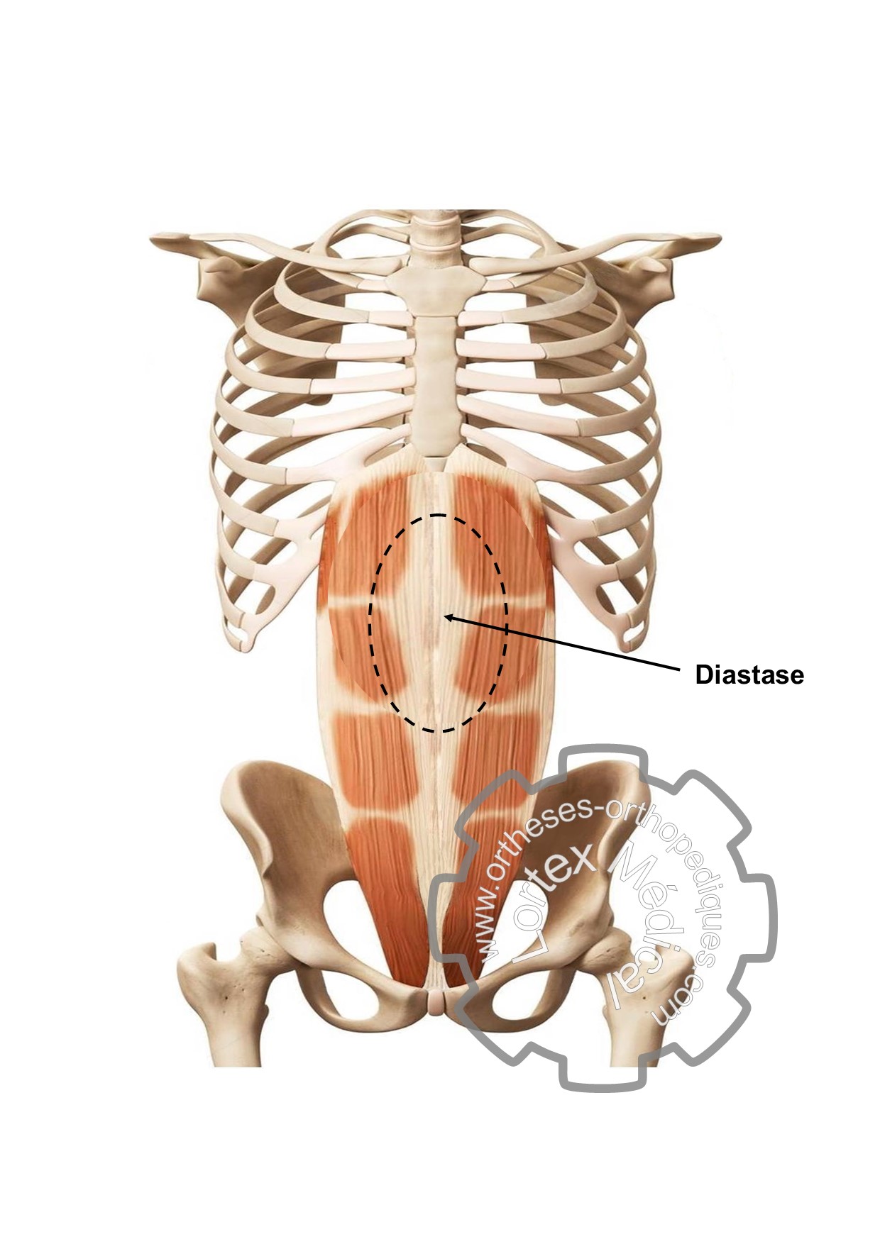 Schéma diastasis