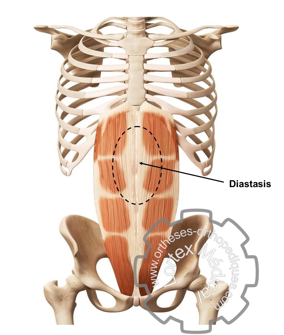 Schéma diastasis