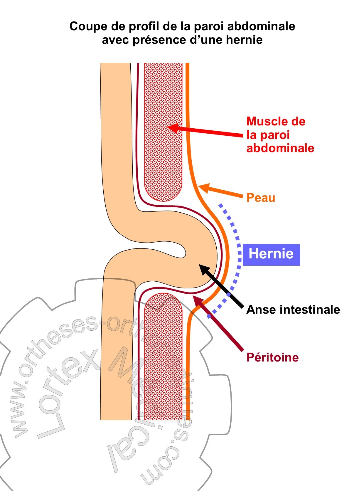 Schéma hernie inguinale